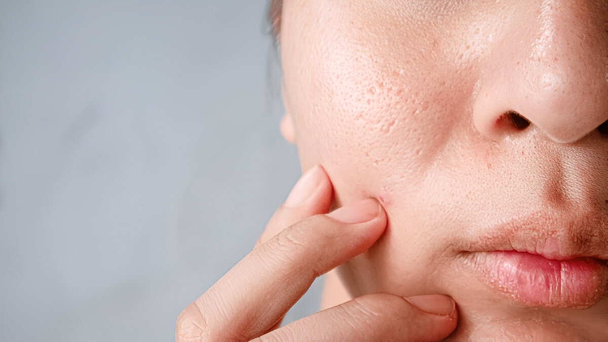 Enlarged pores